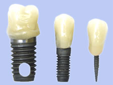 Mini Dental Implants